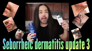 Seborrheic Dermatitis  Update 3 [upl. by Bollay359]