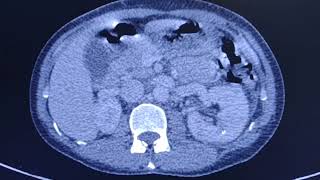 Acute pyelonephritis  CT findings [upl. by Frayda187]