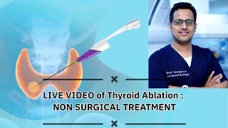 Live Video of Thyroid Ablation  Non Surgical treatment [upl. by Craig]