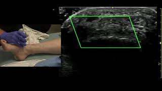 Ultrasound of the Dorsalis Pedis Artery [upl. by Elinor]