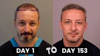 HAIR TRANSPLANT TIMELAPSE  DAY 1 TO DAY 153  GROWTH IN 5 MONTHS  BEFORE amp AFTER [upl. by Annahsat]