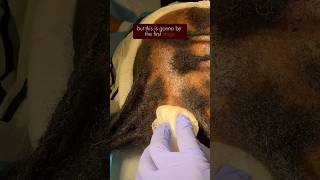 Hair Loss Due to Tight Hairstyles  Hair Transplant on Traction Alopecia [upl. by Nivad958]