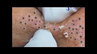 Best Satisfying Blackheads Remove 2019 [upl. by Colp]