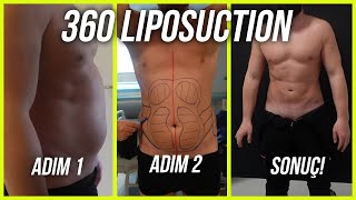 360 derece liposuction  Öncesi Sonrası ile Tüm Süreç [upl. by Lyrak]