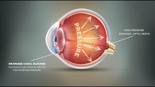 Does hydrogen therapy have a role in the treatment of glaucoma [upl. by Mcripley]