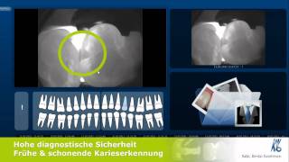 KaVo DIAGNOcam Strahlungsfreie Kariesdiagnostik [upl. by Ahtrim]