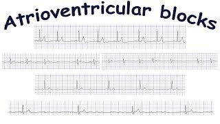 Atrioventricular blocks [upl. by Yngad]