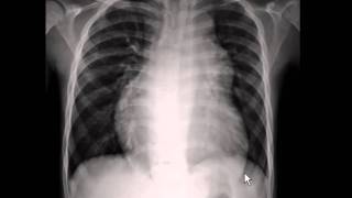 Chest xray  pulmonary arterial hypertension [upl. by Marquet275]