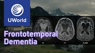 Frontotemporal Dementia vs Alzheimer Disease with Histology  UWorld USMLE MBBS [upl. by Annyrb]