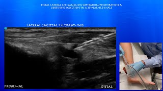 Ultrasound Guided Aspiration and Cortisone Injection of a Ganglion Abutting the Distal Fibula [upl. by Martie732]