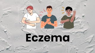 Eczema causes and treatment explained in Hindi [upl. by Ollehto]