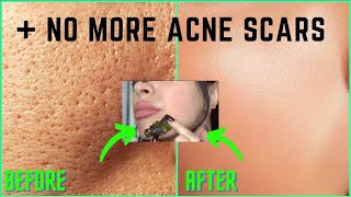 How To Get Rid Of ACNE SCARS  LARGE PORES PERMANENTLY 100 Works All Natural Glass Skin DIY [upl. by Millisent2]