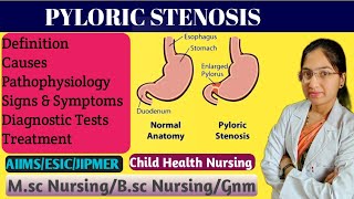 Pyloric Stenosis in Pediatric Nursing  Projectile Vomiting  Causes  Pathophysiology  Treatment [upl. by Nilesoy386]