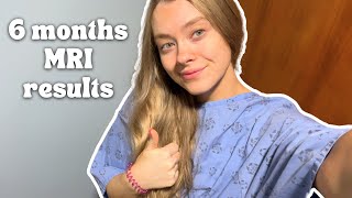 6 Months After Brain Surgery  MRI results  health update [upl. by Sapphire]