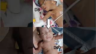 transition alert 😀♥️ viral shortvideo viralvideo doctorslife cutebaby nicu baby youtubeshort [upl. by Eruot]