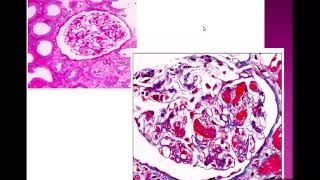 Thrombotic Microangiopathy part 1DrNoha Gamal [upl. by Landel607]