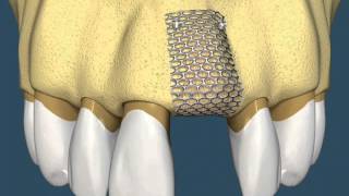 Implantes Dentários  Com Enxerto Ósseo [upl. by Farrand]