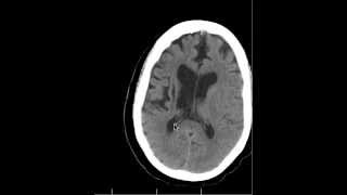 CT Chronic Basal Ganglia infarcts and Anatomy DISCUSSION by Radiologist [upl. by Dorina]