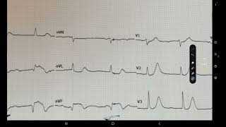 ECG week 15 Syncopal attack [upl. by Llerref]