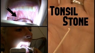 Tonsil Stone REMOVAL [upl. by Desdamonna960]