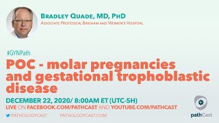 Video 254 Hydatidiform Mole Molar Pregnancy Partial vs Complete Mole amp Associated Risk Factors [upl. by Lleraj]