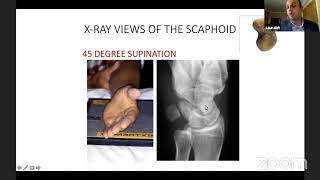 Scaphoid fracture and SNAC wrist by Dr Saurabh Aggarwal [upl. by Munmro]