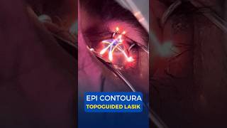 EPI Contoura Topoguided Lasik Surgery [upl. by Kimbra]