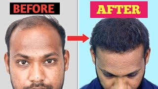 67 Months Natural Results of Hair Transplant  Best Hair Transplant in india 2023  100New Hair [upl. by Jessalin195]