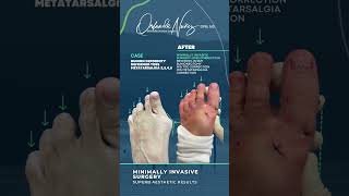 Minimally Invasive Surgery Bunion  Deformity Deformed toes  Metatarsalgia 2345 Before and After [upl. by Guerin]