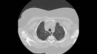 Pulmonary Langerhans cell histiocytosis PLCH on CT [upl. by Quince]