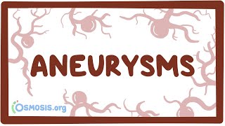 Aneurysms  causes symptoms diagnosis treatment pathology [upl. by Ycam657]