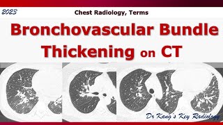 Bronchovascular bundle thickening on CT [upl. by Asenev]