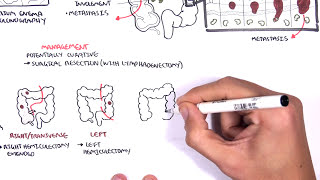 Colorectal Cancer  Overview [upl. by Nepil]