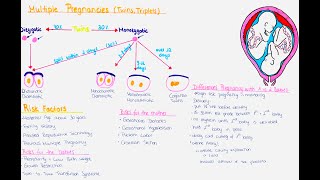 Multiple Pregnancy Twins Triplets  Zygosity Chorionisity Amnionisity Risks Delivery [upl. by Freyah]