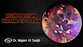 Retinopathy In Thrombocytopenia Indirect Ophthalmoscopy [upl. by Orly513]