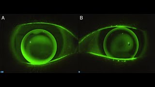 Ideal RGP Lens Fitting Flurosence Pattern ocnseyecareofficial ocns JaivalSheth [upl. by Enirol]