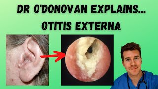 Explaining Otitis Externa  With Dr ODonovan [upl. by Yart132]