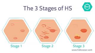 The stages of Hidradenitis Suppurativa [upl. by Luz]