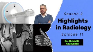 Highlights in Radiology S2 E11 Aneurysmal bone cyst ABC [upl. by Bertie]