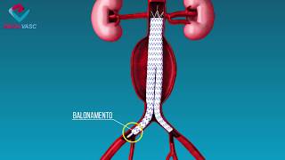 Aneurisma Da Aorta Abdominal [upl. by Afnin]