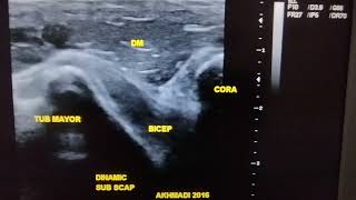 Dynamic Ultrasound in Shoulder Impingement [upl. by Lilithe]