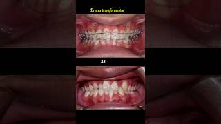 Cross bite braces transformation braces orthodontist dentist [upl. by Ander]