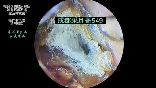 Hard cerumen embolism fungal infection ｜549 [upl. by Lauro]