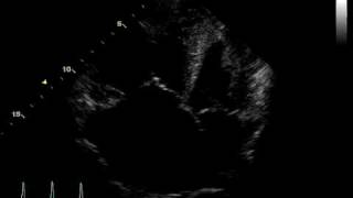 ACUTE PULMONARY HEART DISEASE  THROMBUS PULMONARY ARTERY [upl. by Burt]