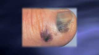 Skin Exams Catching Melanoma Earlier [upl. by Liesa]