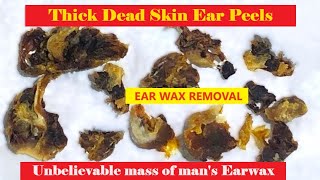 TOTAL OBSTRUCTION  EAR WAX REMOVAL  FULLHD  202312 relaxing satisfying asmr [upl. by Aborn453]