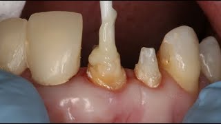 Dental Core Build Up and Post Cementation  Dental Online Training [upl. by Rosaleen46]