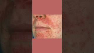 Why Your Perioral Dermatitis Won’t Heal dermatologist [upl. by Arrat13]