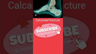 Calcaneal fracture anatomy orthopedics short [upl. by Agee119]