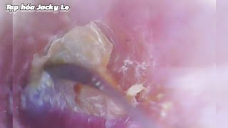 Ear Wax Removal 178 Ear fungus is very itchy  Ear Cleaning ASMR [upl. by Scheers305]